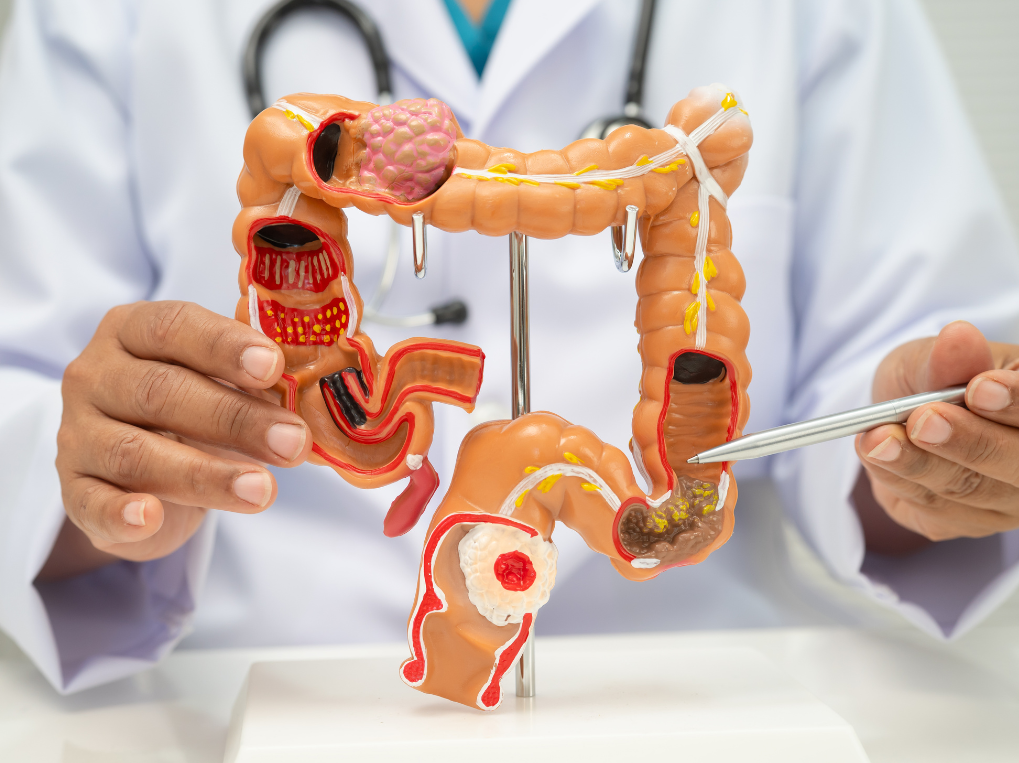 colon cancer